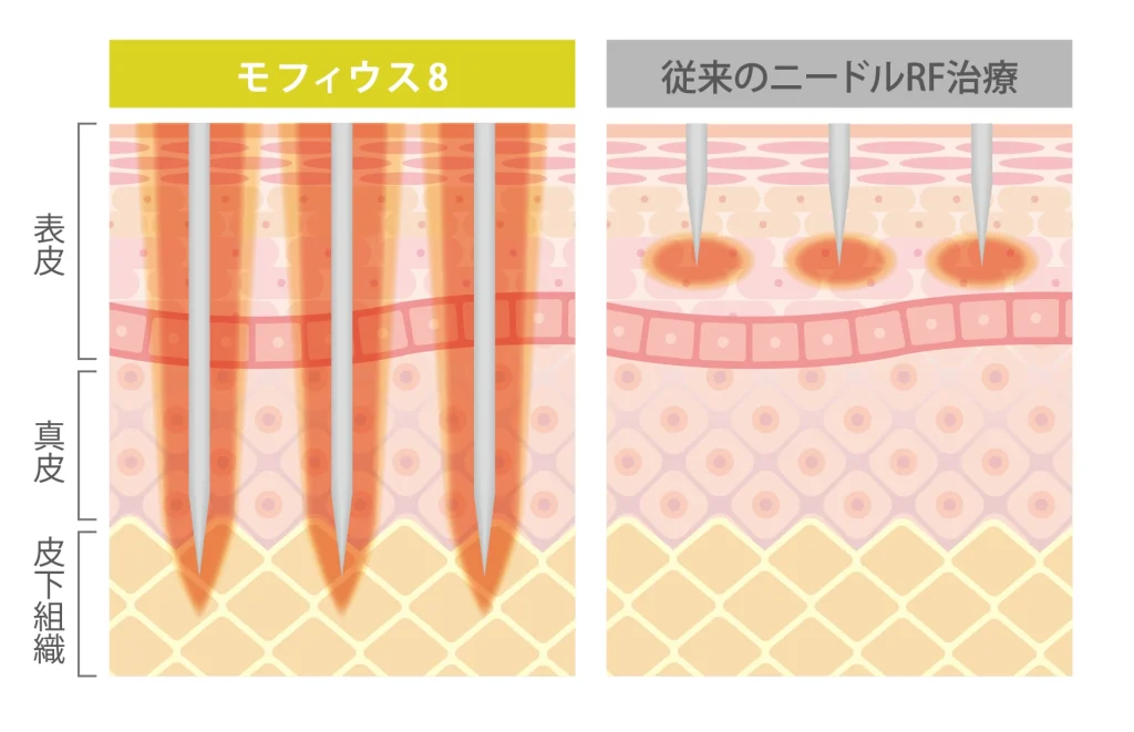 モフィウス8